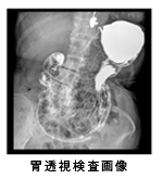 胃透視検査画像